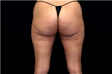 Thigh Lift After Photo by Landon Pryor, MD, FACS; Rockford, IL - Case 47739