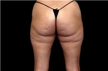 Thigh Lift Before Photo by Landon Pryor, MD, FACS; Rockford, IL - Case 47739