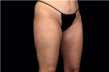 Thigh Lift After Photo by Landon Pryor, MD, FACS; Rockford, IL - Case 47739