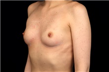 Breast Augmentation Before Photo by Landon Pryor, MD, FACS; Rockford, IL - Case 47742
