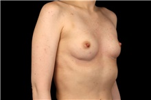 Breast Augmentation Before Photo by Landon Pryor, MD, FACS; Rockford, IL - Case 47742