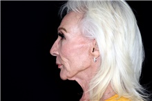 Facelift Before Photo by Landon Pryor, MD, FACS; Rockford, IL - Case 47744