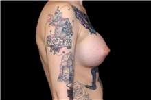 Breast Augmentation After Photo by Landon Pryor, MD, FACS; Rockford, IL - Case 47745