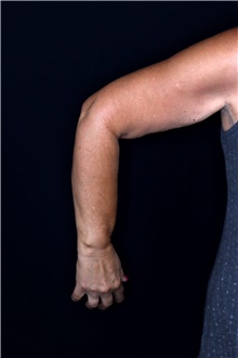 Arm Lift Before Photo by Landon Pryor, MD, FACS; Rockford, IL - Case 47746