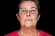 Facelift Before Photo by Landon Pryor, MD, FACS; Rockford, IL - Case 47747