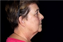 Facelift Before Photo by Landon Pryor, MD, FACS; Rockford, IL - Case 47747