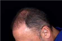 Hair Transplant After Photo by Landon Pryor, MD, FACS; Rockford, IL - Case 47748
