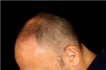 Hair Transplant Before Photo by Landon Pryor, MD, FACS; Rockford, IL - Case 47748