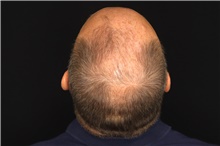 Hair Transplant Before Photo by Landon Pryor, MD, FACS; Rockford, IL - Case 47748