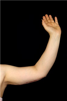 Arm Lift After Photo by Landon Pryor, MD, FACS; Rockford, IL - Case 47873