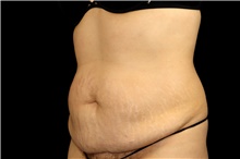 Tummy Tuck Before Photo by Landon Pryor, MD, FACS; Rockford, IL - Case 47874