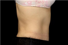 Tummy Tuck After Photo by Landon Pryor, MD, FACS; Rockford, IL - Case 47874