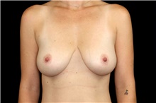 Breast Reduction Before Photo by Landon Pryor, MD, FACS; Rockford, IL - Case 47875