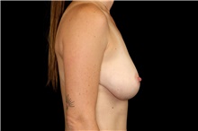 Breast Reduction Before Photo by Landon Pryor, MD, FACS; Rockford, IL - Case 47875