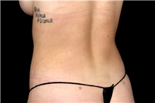 Liposuction After Photo by Landon Pryor, MD, FACS; Rockford, IL - Case 47876