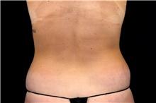 Liposuction Before Photo by Landon Pryor, MD, FACS; Rockford, IL - Case 47876