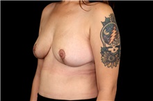 Breast Implant Removal After Photo by Landon Pryor, MD, FACS; Rockford, IL - Case 47877