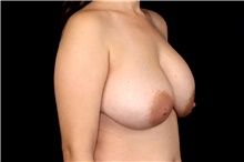 Breast Implant Removal Before Photo by Landon Pryor, MD, FACS; Rockford, IL - Case 47877
