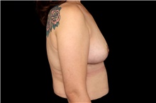 Breast Implant Removal After Photo by Landon Pryor, MD, FACS; Rockford, IL - Case 47877