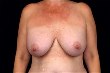Breast Implant Removal Before Photo by Landon Pryor, MD, FACS; Rockford, IL - Case 47880