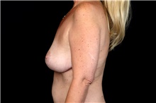 Breast Implant Removal After Photo by Landon Pryor, MD, FACS; Rockford, IL - Case 47880