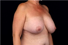 Breast Implant Removal Before Photo by Landon Pryor, MD, FACS; Rockford, IL - Case 47880