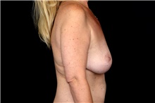 Breast Implant Removal After Photo by Landon Pryor, MD, FACS; Rockford, IL - Case 47880