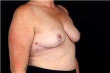 Breast Implant Removal After Photo by Landon Pryor, MD, FACS; Rockford, IL - Case 47881