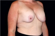 Breast Implant Removal Before Photo by Landon Pryor, MD, FACS; Rockford, IL - Case 47881