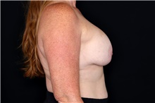 Breast Implant Removal Before Photo by Landon Pryor, MD, FACS; Rockford, IL - Case 47881