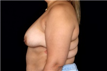 Breast Implant Removal Before Photo by Landon Pryor, MD, FACS; Rockford, IL - Case 47882