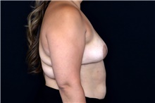 Breast Implant Removal After Photo by Landon Pryor, MD, FACS; Rockford, IL - Case 47882