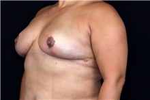 Breast Implant Removal After Photo by Landon Pryor, MD, FACS; Rockford, IL - Case 47883