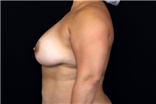 Breast Implant Removal Before Photo by Landon Pryor, MD, FACS; Rockford, IL - Case 47883