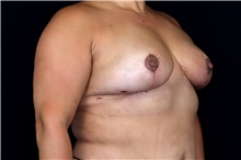 Breast Implant Removal After Photo by Landon Pryor, MD, FACS; Rockford, IL - Case 47883