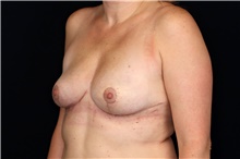 Breast Implant Removal After Photo by Landon Pryor, MD, FACS; Rockford, IL - Case 47884