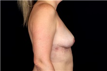 Breast Implant Removal After Photo by Landon Pryor, MD, FACS; Rockford, IL - Case 47884