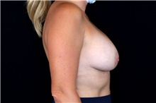 Breast Implant Removal Before Photo by Landon Pryor, MD, FACS; Rockford, IL - Case 47884
