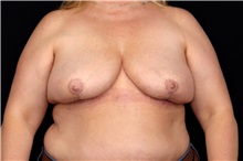 Breast Implant Removal After Photo by Landon Pryor, MD, FACS; Rockford, IL - Case 49427