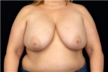 Breast Implant Removal Before Photo by Landon Pryor, MD, FACS; Rockford, IL - Case 49427