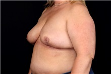 Breast Implant Removal After Photo by Landon Pryor, MD, FACS; Rockford, IL - Case 49427