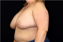 Breast Implant Removal Before Photo by Landon Pryor, MD, FACS; Rockford, IL - Case 49427