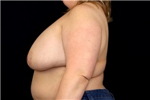 Breast Implant Removal Before Photo by Landon Pryor, MD, FACS; Rockford, IL - Case 49427