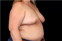 Breast Implant Removal After Photo by Landon Pryor, MD, FACS; Rockford, IL - Case 49427