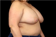 Breast Implant Removal Before Photo by Landon Pryor, MD, FACS; Rockford, IL - Case 49427