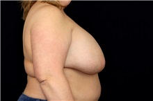 Breast Implant Removal Before Photo by Landon Pryor, MD, FACS; Rockford, IL - Case 49427