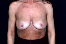 Breast Implant Removal After Photo by Landon Pryor, MD, FACS; Rockford, IL - Case 49429