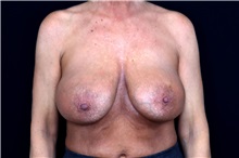 Breast Implant Removal Before Photo by Landon Pryor, MD, FACS; Rockford, IL - Case 49429