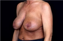 Breast Implant Removal Before Photo by Landon Pryor, MD, FACS; Rockford, IL - Case 49429