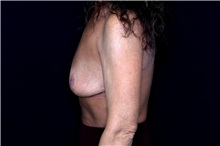 Breast Implant Removal After Photo by Landon Pryor, MD, FACS; Rockford, IL - Case 49429